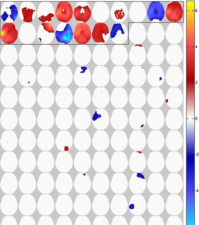 3D Statistical Parametric Mapping of quiet sleep EEG in the first year of life 3D Statistical Parametric Mapping of quiet sleep EEG in the first year of life