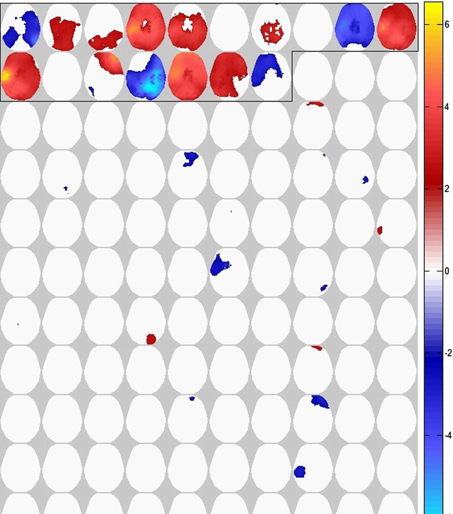 3D Statistical Parametric Mapping of quiet sleep EEG in the first year of life